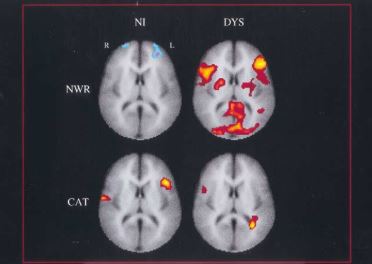 Neuroimage (Shaywitz et al., 2002)